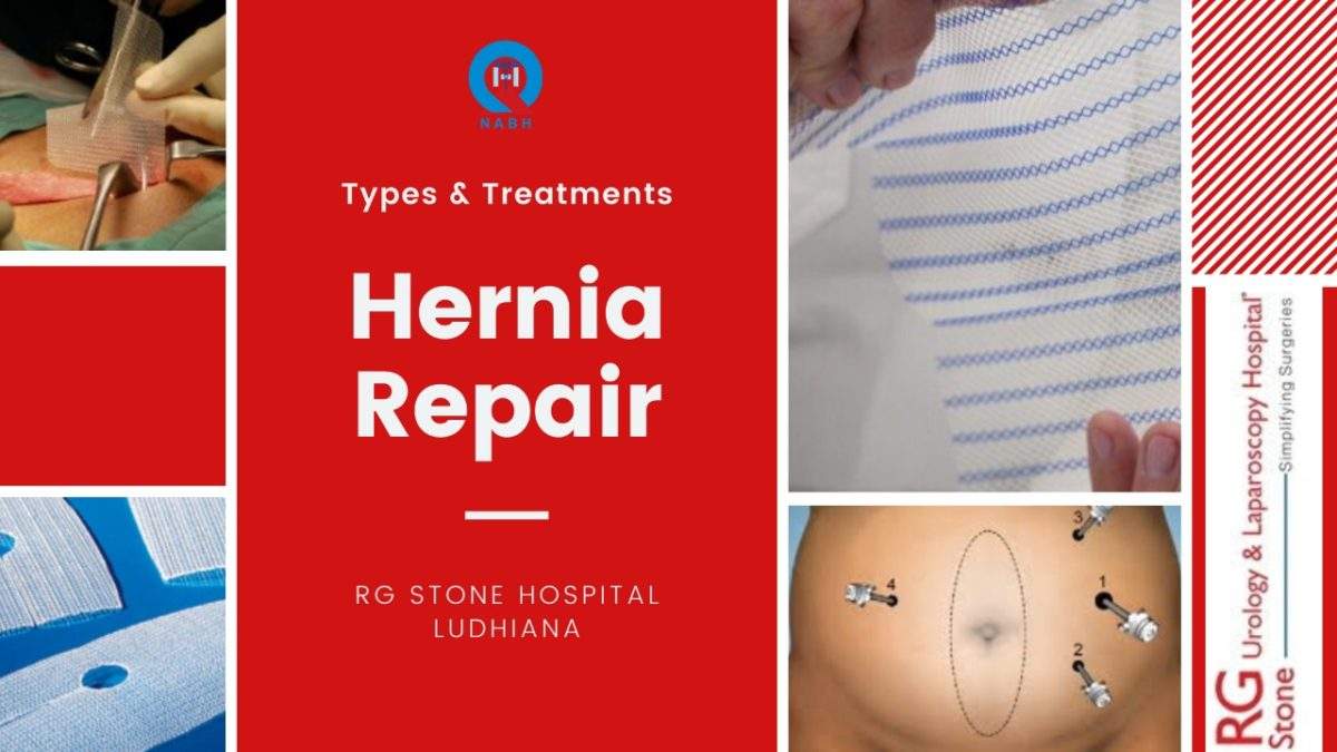 Hernia repair